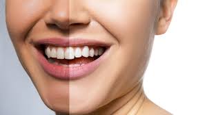 Snowhite Teeth Whitening – تعليقات -إنه يعمل – Extract