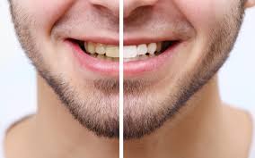 Snowhite Teeth Whitening– أجهزة لوحية – يشترى – منتدى
